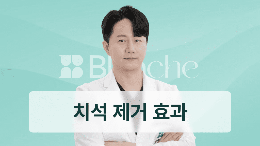 스케일링 치석 한 번으로 끝? 치석 제거 효과와 예방까지 완벽 정리