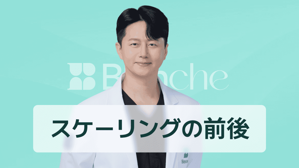 【韓国歯科】スケーリング前後の変化や痛みまで完璧に整理 歯が白くなる本当の理由を公開