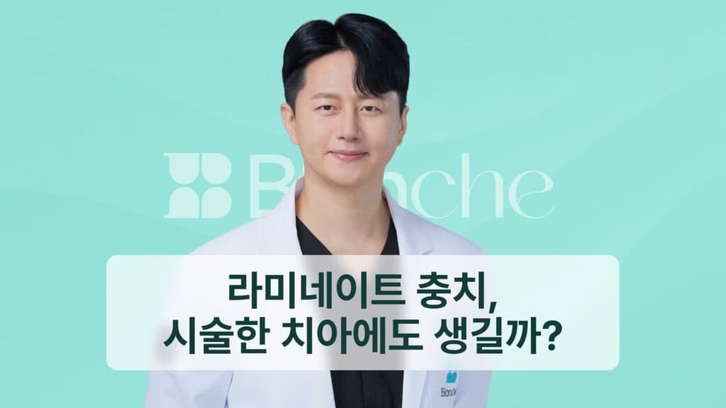라미네이트 충치, 시술한 치아에도 생길까?