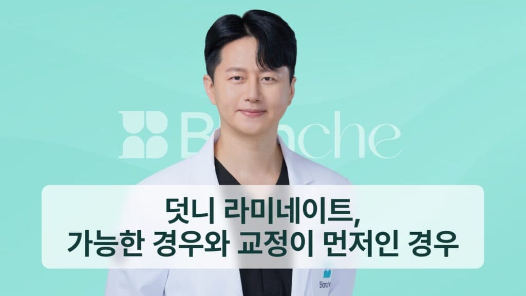썸네일 - 덧니 라미네이트