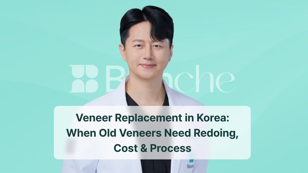 Veneer Replacement in Korea: When Old Veneers Need Redoing, Cost & Process