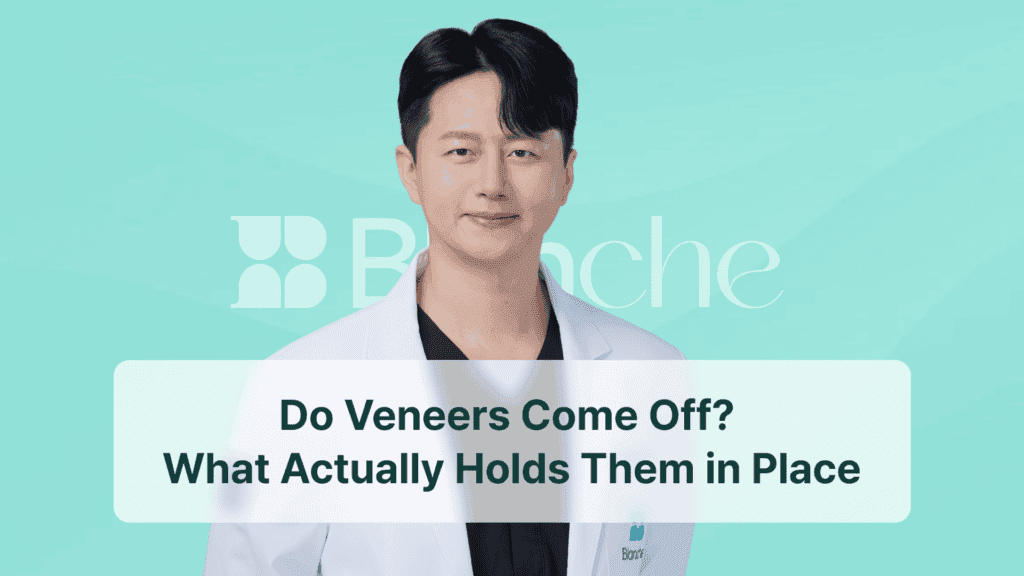 Do Veneers Come Off? What Actually Holds Them in Place