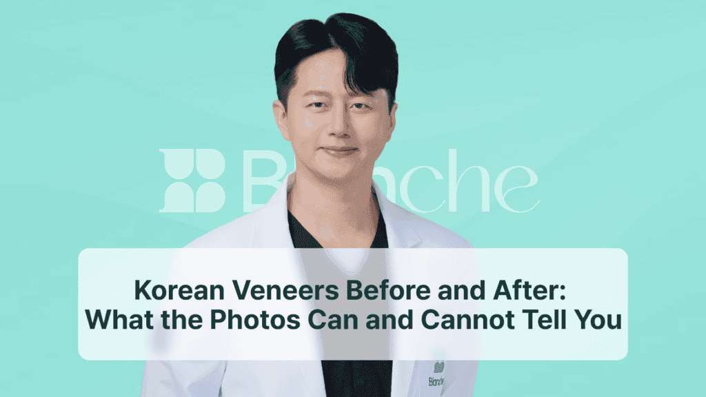 Korean Veneers Before and After: What the Photos Can and Cannot Tell You
