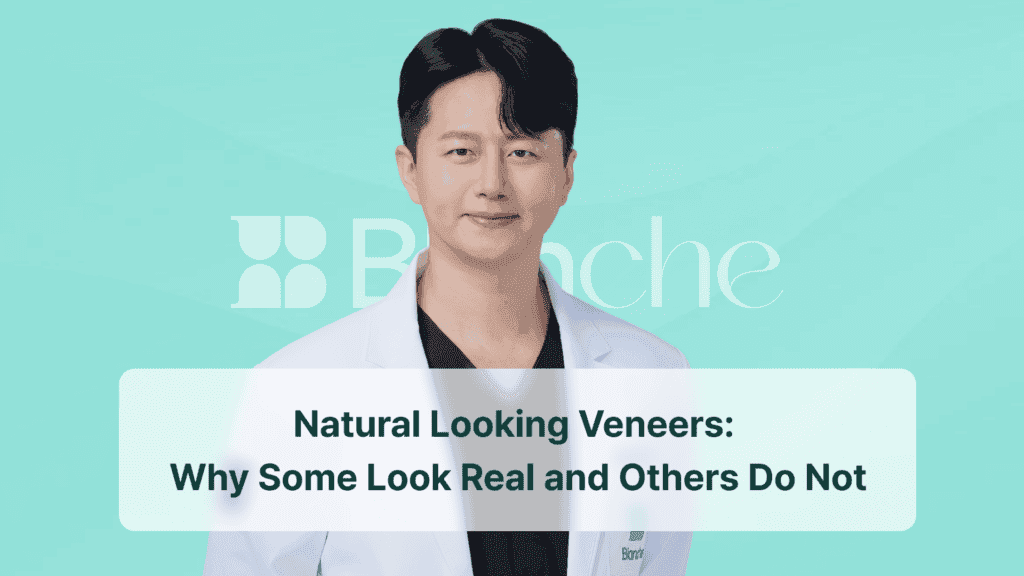 Natural Looking Veneers: Why Some Look Real and Others Do Not
