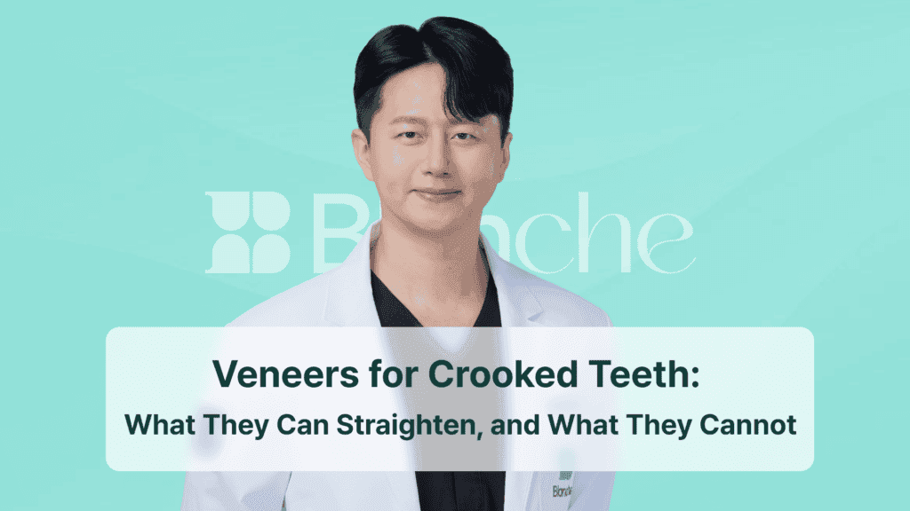 Veneers for Crooked Teeth: What They Can Straighten, and What They Cannot