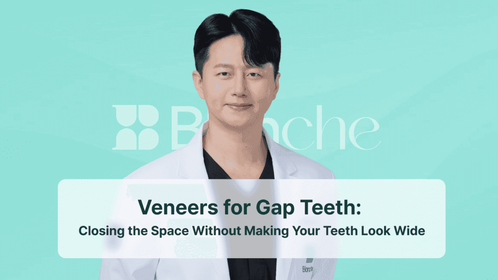 Veneers for Gap Teeth: Closing the Space Without Making Your Teeth Look Wide