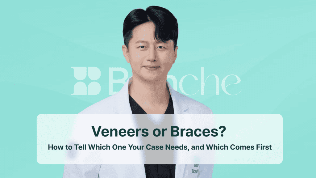 Veneers or Braces? How to Tell Which One Your Case Needs, and Which Comes First
