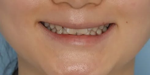 토끼이빨