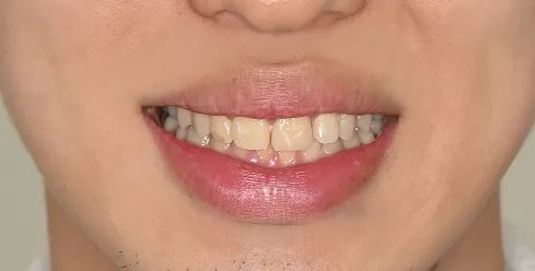 치아 변색