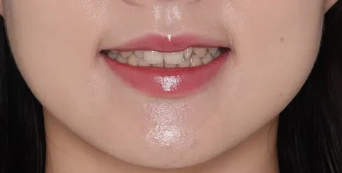 불규칙한 치열