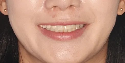 라미네이트 재시술