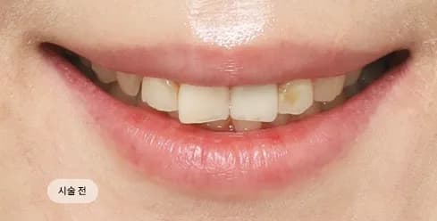 Before Treatment