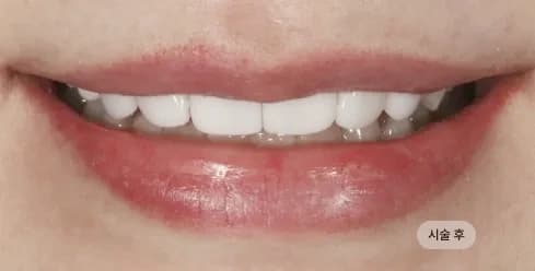 After Treatment