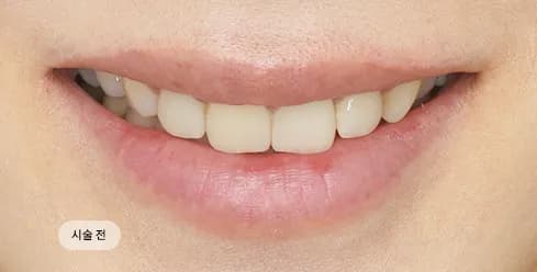 Before Treatment