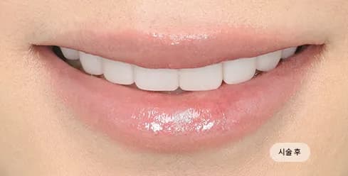 After Treatment