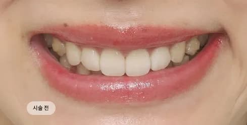 Before Treatment