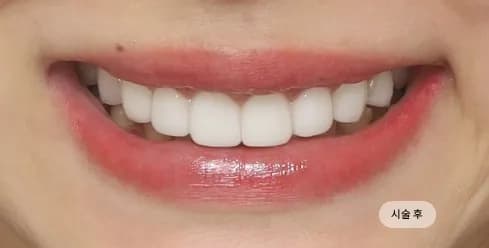 After Treatment