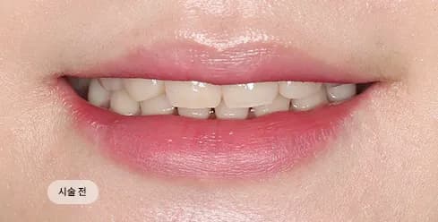 Before Treatment
