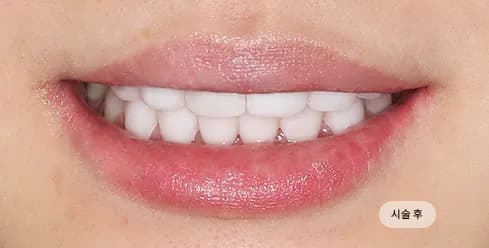 After Treatment
