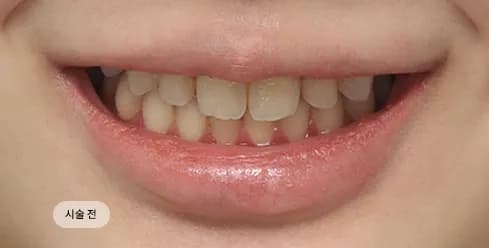 Before Treatment