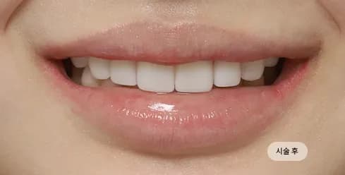 After Treatment