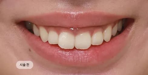 Before Treatment