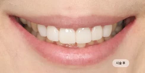 After Treatment