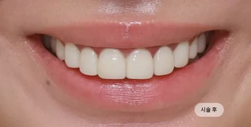 After Treatment