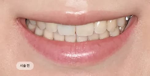Before Treatment