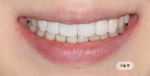After Treatment