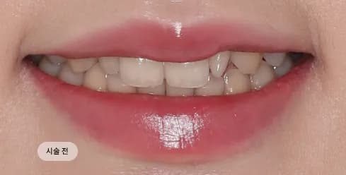 Before Treatment
