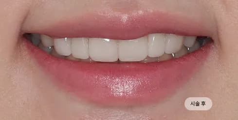 After Treatment