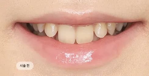 Before Treatment