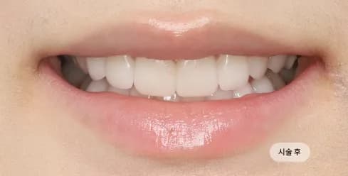 After Treatment