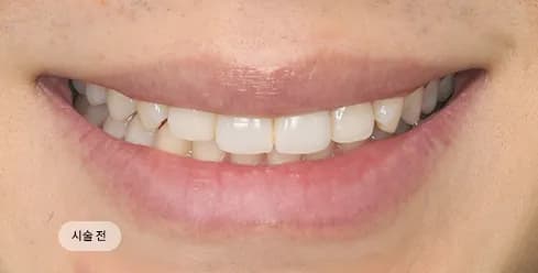 Before Treatment