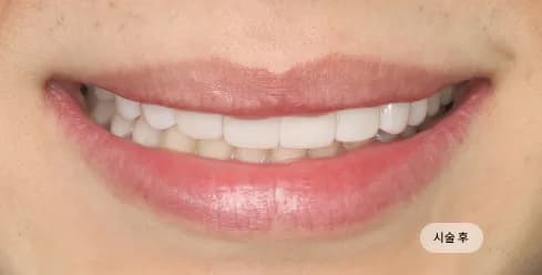 After Treatment