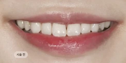 Before Treatment
