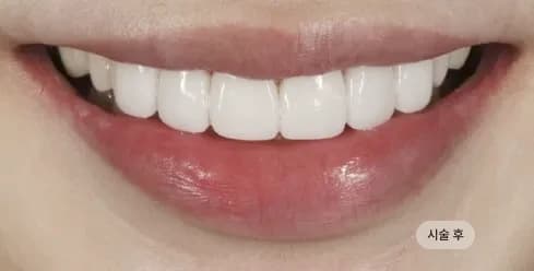 After Treatment