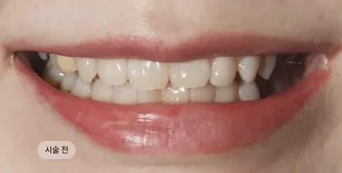 Before Treatment
