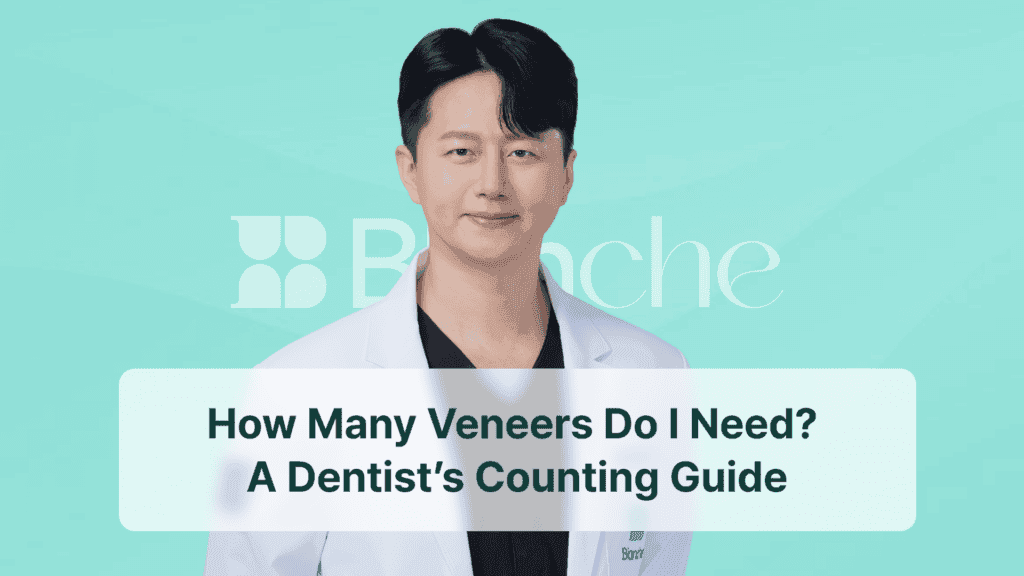 How Many Veneers Do I Need? A Dentist’s Counting Guide